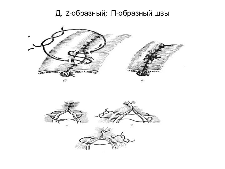 Д. Z-образный; П-образный швы