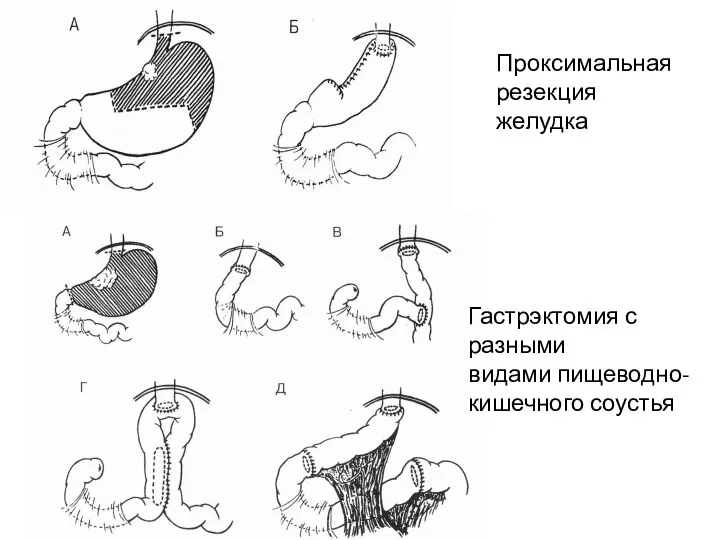 Проксимальная резекция желудка Гастрэктомия с разными видами пищеводно- кишечного соустья