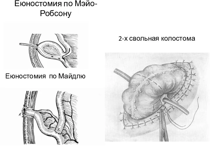 Еюностомия по Мэйо-Робсону Еюностомия по Майдлю 2-х свольная колостома