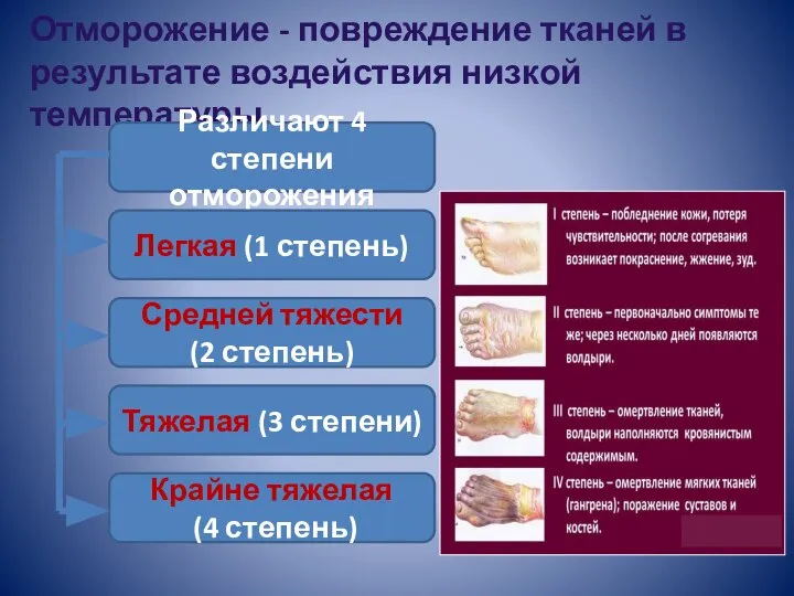 Отморожение - повреждение тканей в результате воздействия низкой температуры. Различают 4