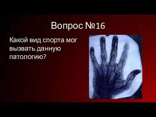 Вопрос №16 Какой вид спорта мог вызвать данную патологию?