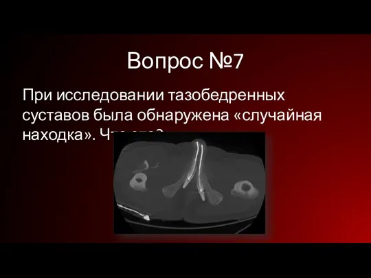 Вопрос №7 При исследовании тазобедренных суставов была обнаружена «случайная находка». Что это?