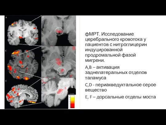 фМРТ. Исследование церебрального кровотока у пациентов с нитроглицерин индуцированной продромальной фазой