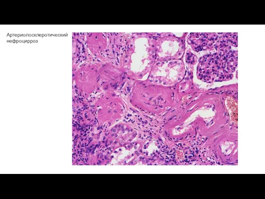 Артериолосклеротический нефроцирроз