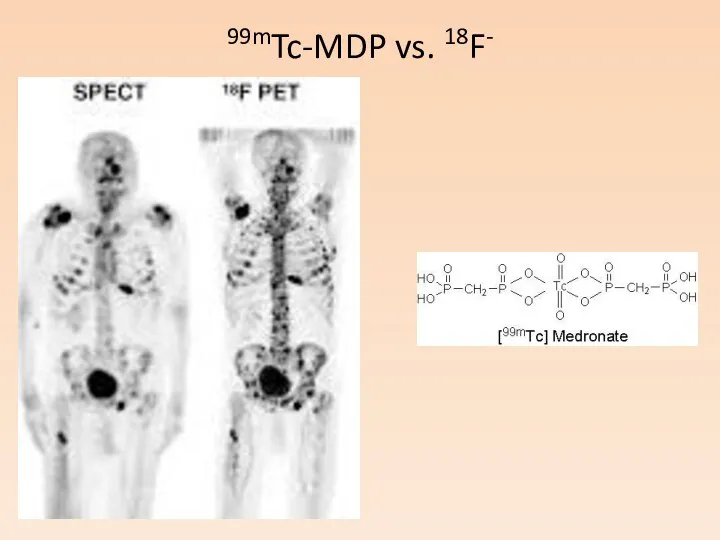 99mTc-MDP vs. 18F-