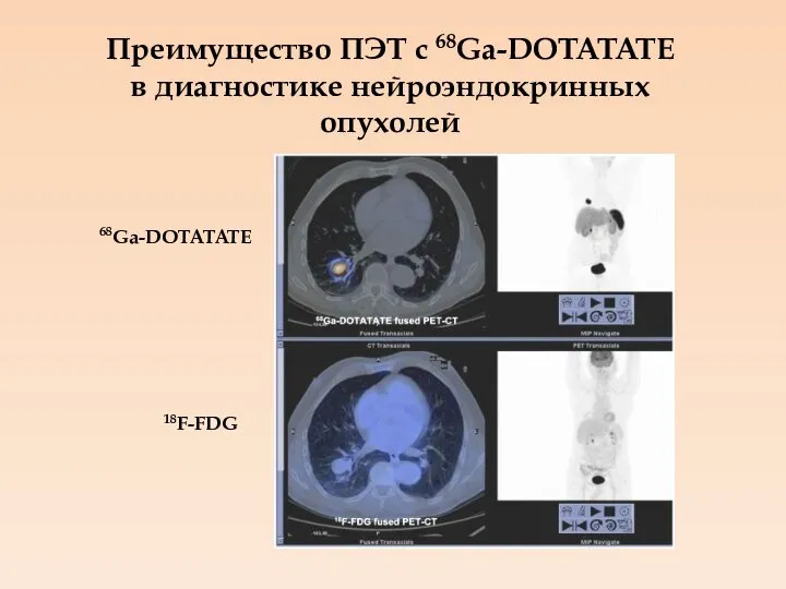 Преимущество ПЭТ с 68Ga-DOTATATE в диагностике нейроэндокринных опухолей