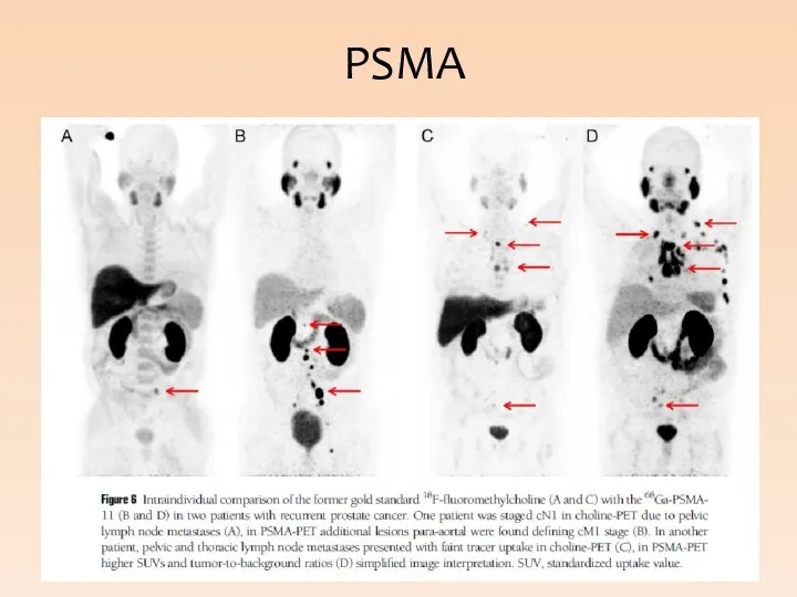 PSMA