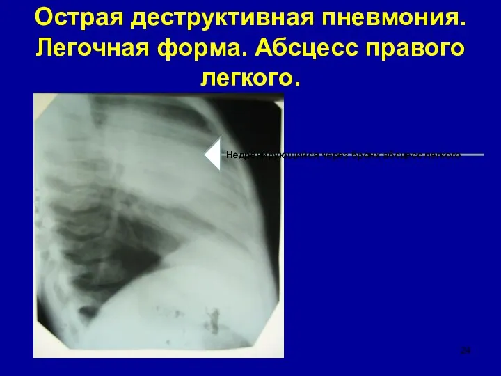 Острая деструктивная пневмония. Легочная форма. Абсцесс правого легкого. Недренирующийся через бронх абсцесс легкого