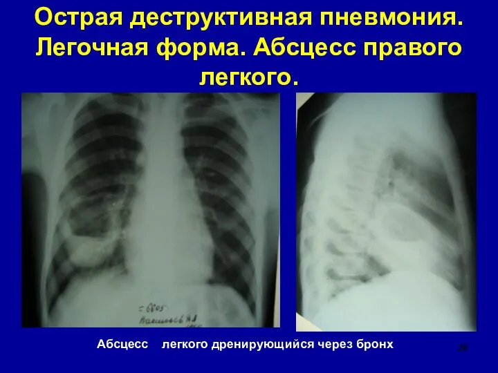Острая деструктивная пневмония. Легочная форма. Абсцесс правого легкого. Абсцесс легкого дренирующийся через бронх