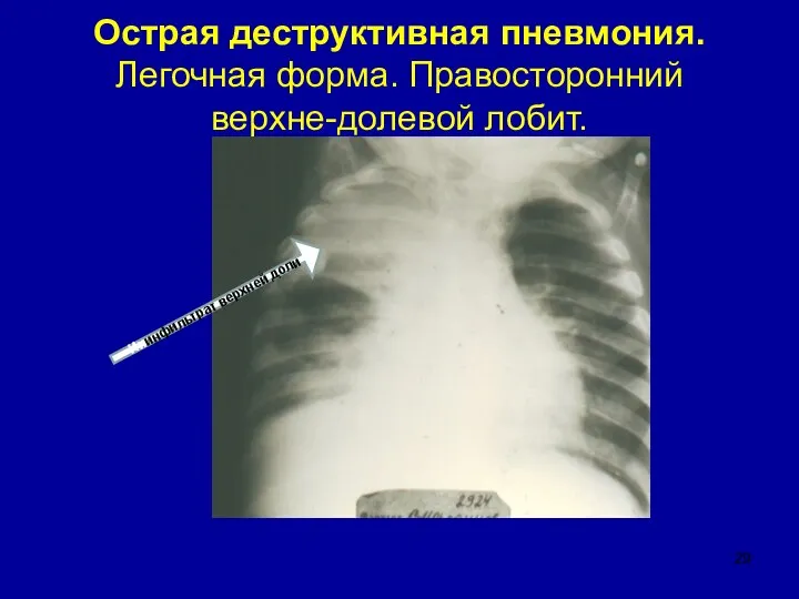 Острая деструктивная пневмония. Легочная форма. Правосторонний верхне-долевой лобит. Ииинфильтрат верхней доли