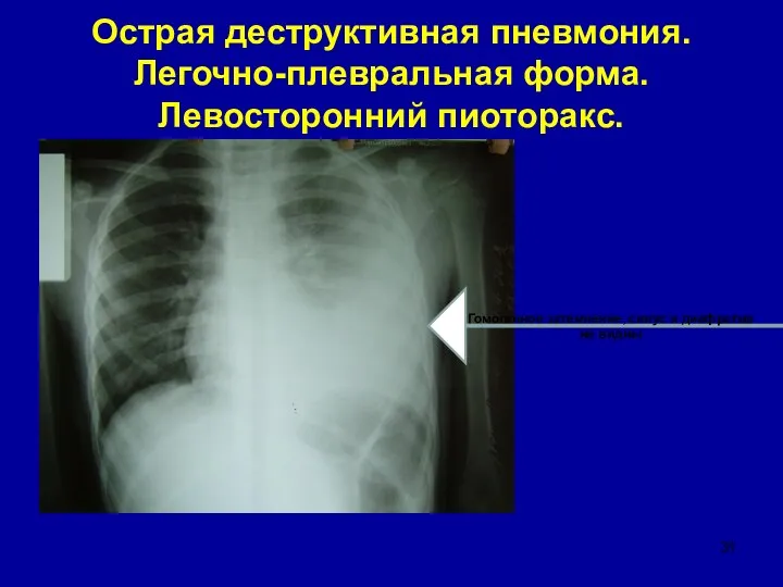 Острая деструктивная пневмония. Легочно-плевральная форма. Левосторонний пиоторакс. Гомогенное затемнение, синус и диафрагма не видны