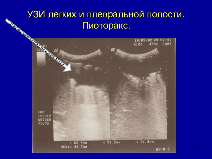 УЗИ легких и плевральной полости. Пиоторакс. Наличие мелкодисперстной взвеси(гноя)а