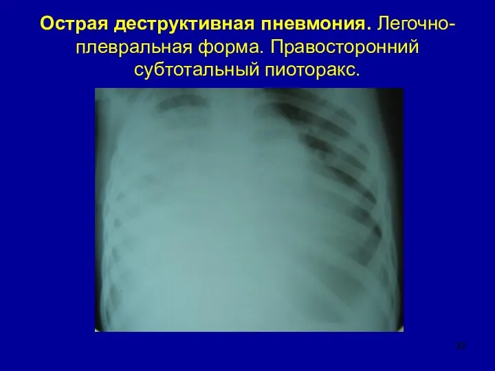 Острая деструктивная пневмония. Легочно-плевральная форма. Правосторонний субтотальный пиоторакс.