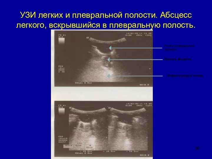 УЗИ легких и плевральной полости. Абсцесс легкого, вскрывшийся в плевральную полость.