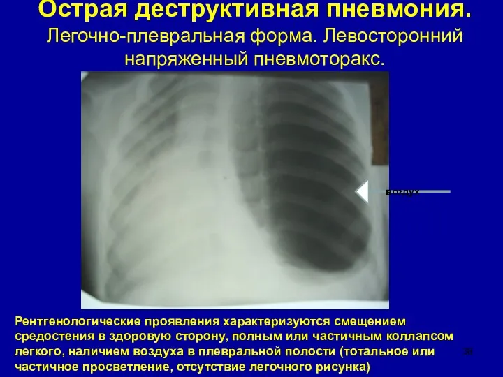 Острая деструктивная пневмония. Легочно-плевральная форма. Левосторонний напряженный пневмоторакс. Рентгенологические проявления характеризуются