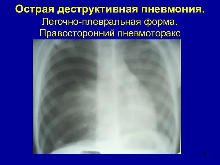 Острая деструктивная пневмония. Легочно-плевральная форма. Правосторонний пневмоторакс