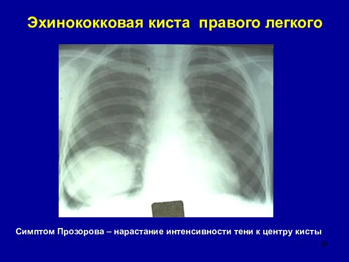 Эхинококковая киста правого легкого Симптом Прозорова – нарастание интенсивности тени к центру кисты