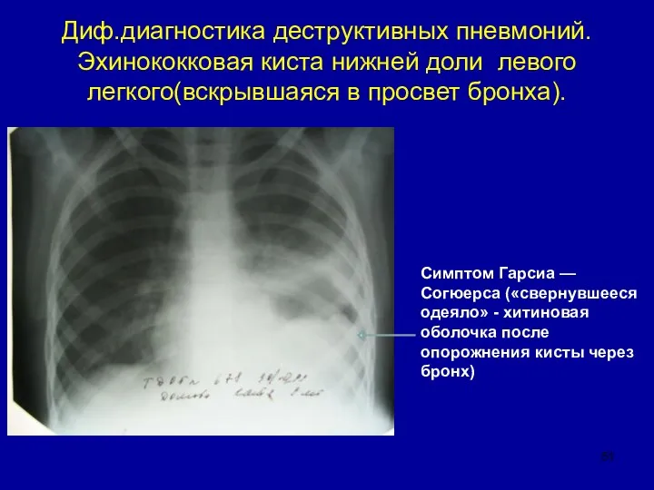 Диф.диагностика деструктивных пневмоний. Эхинококковая киста нижней доли левого легкого(вскрывшаяся в просвет