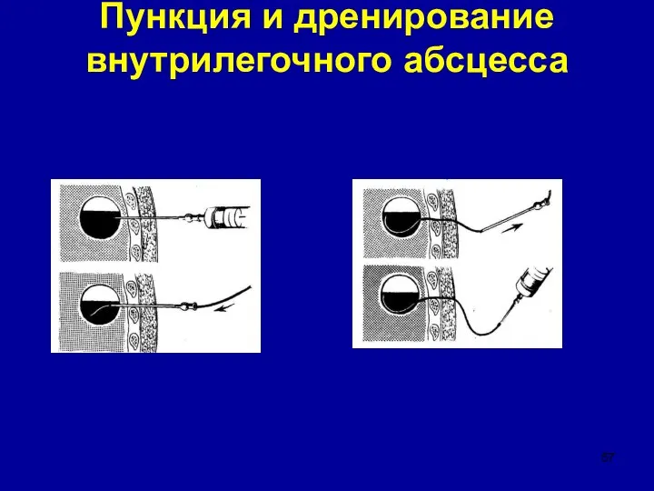 Пункция и дренирование внутрилегочного абсцесса