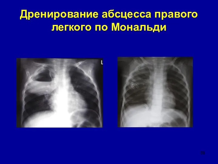 Дренирование абсцесса правого легкого по Мональди