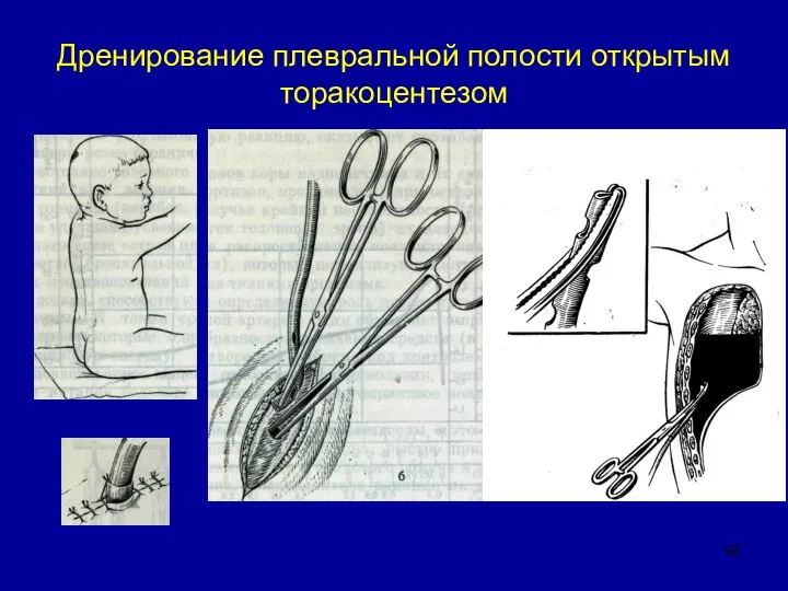 Дренирование плевральной полости открытым торакоцентезом