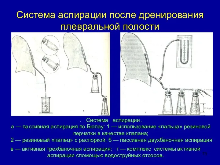 Система аспирации после дренирования плевральной полости . Система аспирации. а —