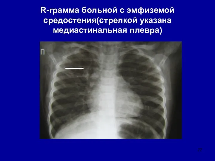 R-грамма больной с эмфиземой средостения(стрелкой указана медиастинальная плевра)