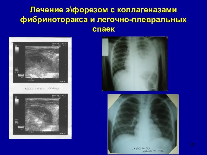 Лечение э\форезом с коллагеназами фибриноторакса и легочно-плевральных спаек