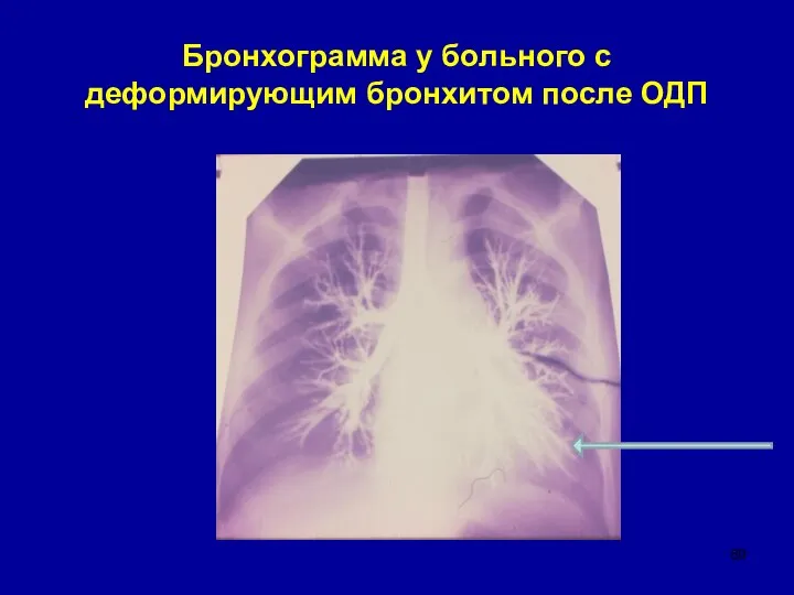 Бронхограмма у больного с деформирующим бронхитом после ОДП