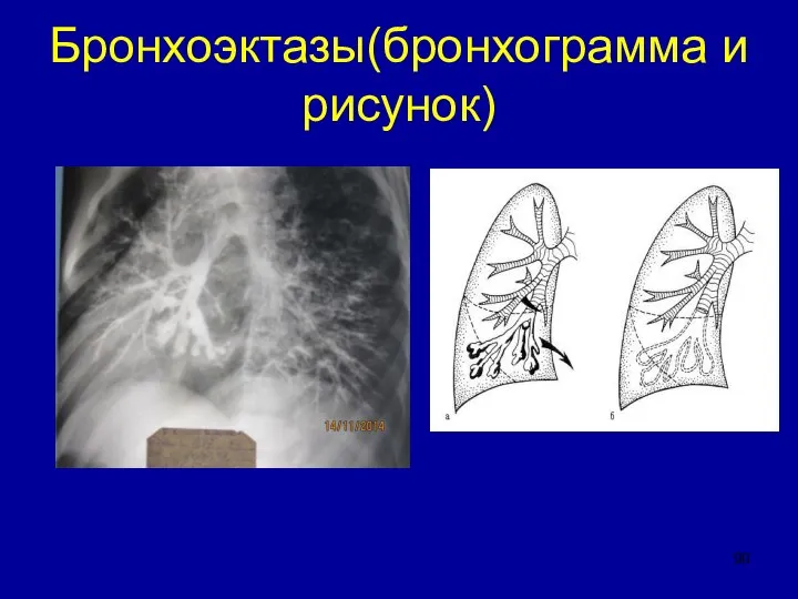 Бронхоэктазы(бронхограмма и рисунок)