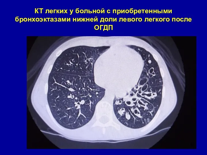 КТ легких у больной с приобретенными бронхоэктазами нижней доли левого легкого после ОГДП