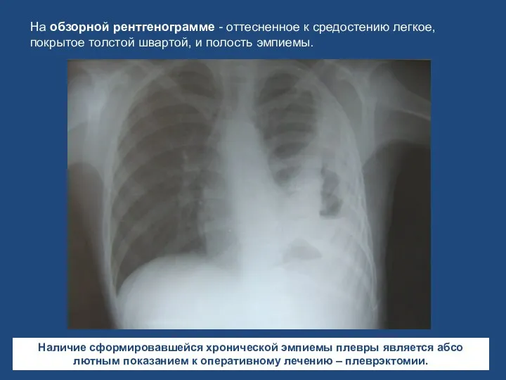 На обзорной рентгенограмме - оттесненное к средостению легкое, покрытое тол­стой швартой,