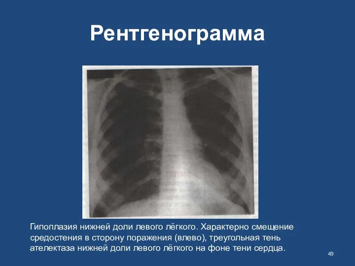 Рентгенограмма Гипоплазия нижней доли левого лёгкого. Характерно смещение средостения в сторону