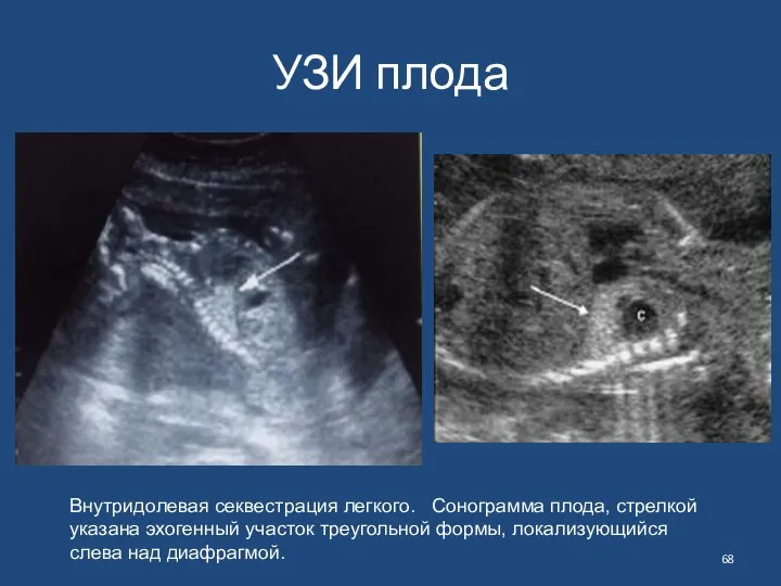 УЗИ плода Внутридолевая секвестрация легкого. Сонограмма плода, стрелкой указана эхогенный участок