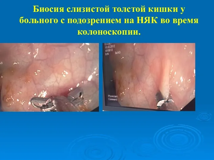 Биосия слизистой толстой кишки у больного с подозрением на НЯК во время колоноскопии.