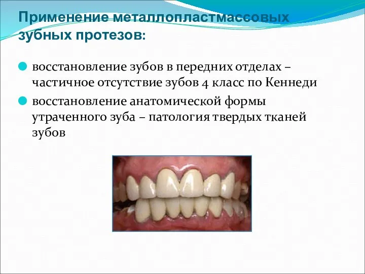 Применение металлопластмассовых зубных протезов: восстановление зубов в передних отделах – частичное