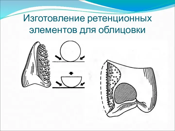 Изготовление ретенционных элементов для облицовки