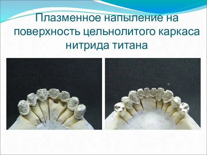 Плазменное напыление на поверхность цельнолитого каркаса нитрида титана