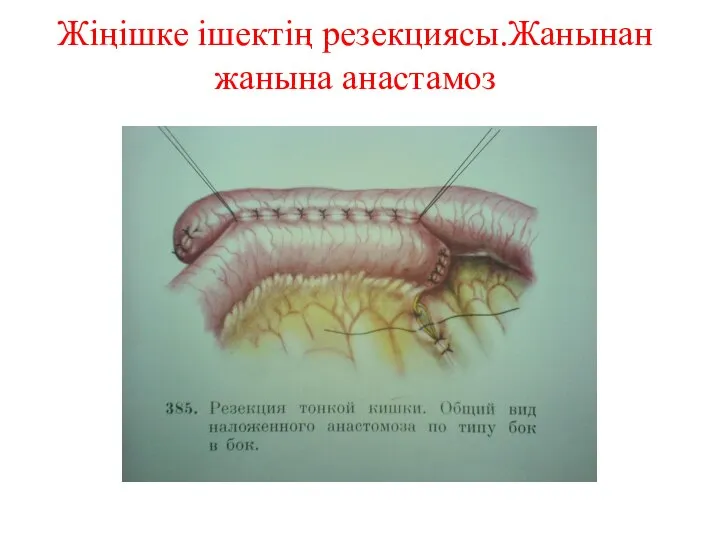 Жіңішке ішектің резекциясы.Жанынан жанына анастамоз