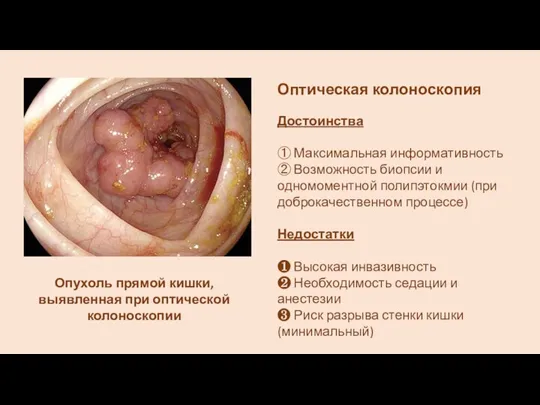 Опухоль прямой кишки, выявленная при оптической колоноскопии Оптическая колоноскопия Достоинства ①