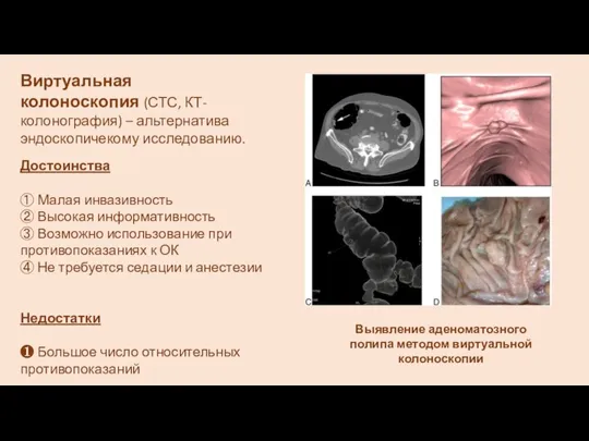 Выявление аденоматозного полипа методом виртуальной колоноскопии Виртуальная колоноскопия (СТС, КТ-колонография) –