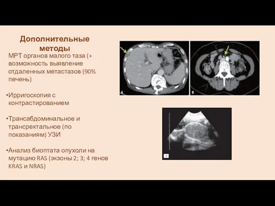 МРТ органов малого таза (+ возможность выявление отдаленных метастазов (90% печень)