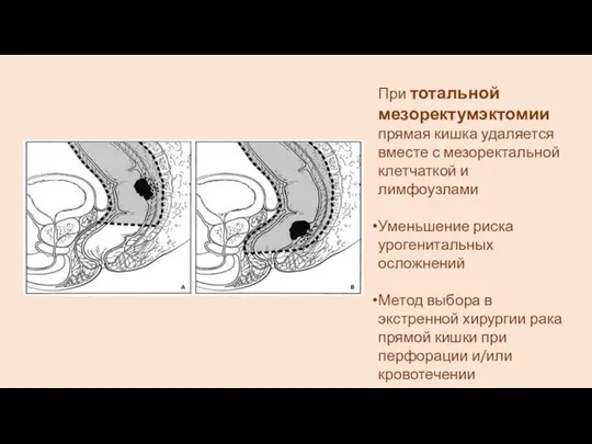 При тотальной мезоректумэктомии прямая кишка удаляется вместе с мезоректальной клетчаткой и