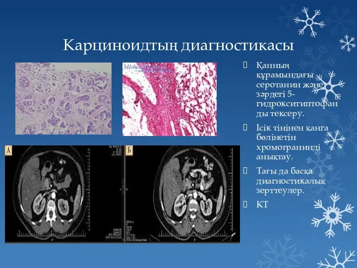 Карциноидтың диагностикасы Қанның құрамындағы серотанин және зәрдегі 5-гидрокситиптофанды тексеру. Ісік тінінен