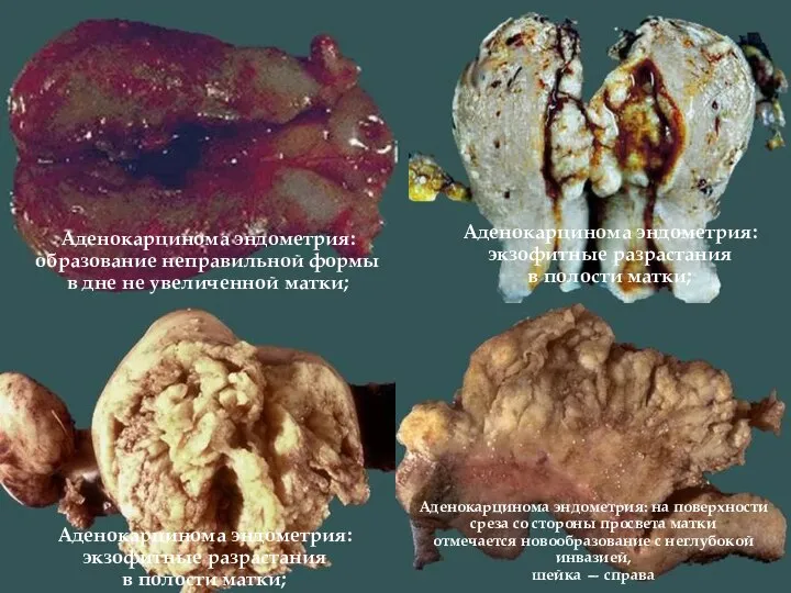 Аденокарцинома эндометрия: образование неправильной формы в дне не увеличенной матки; Аденокарцинома