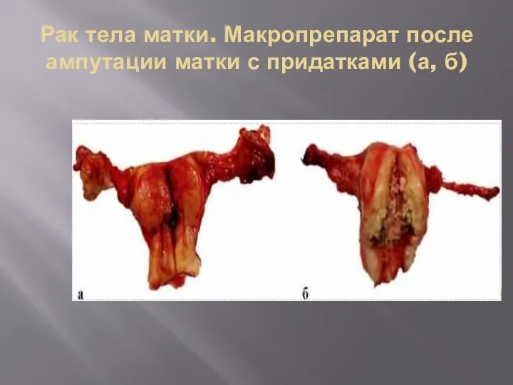 Рак тела матки. Макропрепарат после ампутации матки с придатками (а, б)