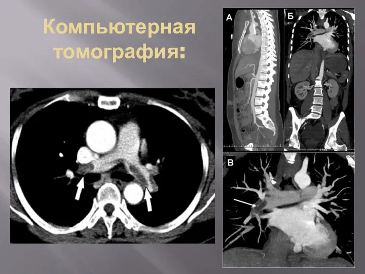 Компьютерная томография: