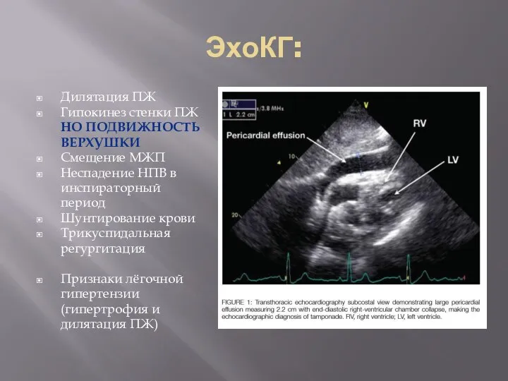 ЭхоКГ: Дилятация ПЖ Гипокинез стенки ПЖ НО ПОДВИЖНОСТЬ ВЕРХУШКИ Смещение МЖП