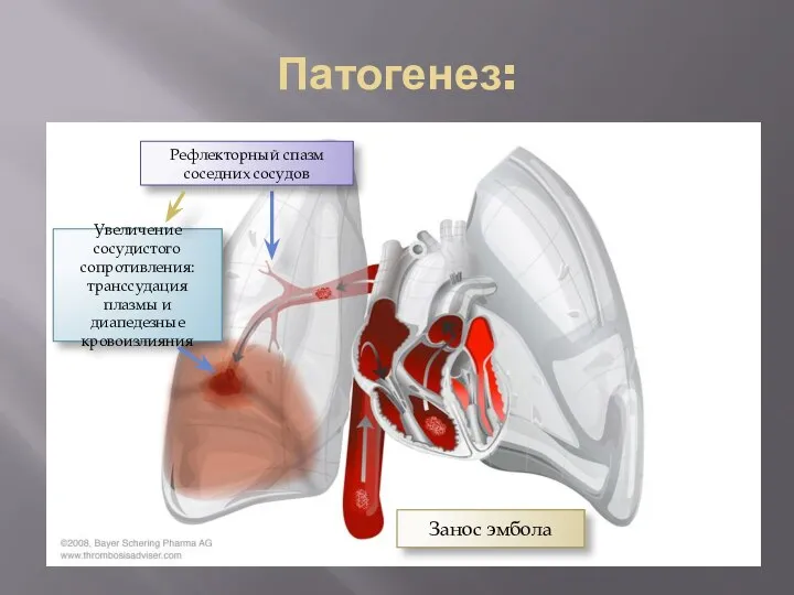 Патогенез: Занос эмбола Увеличение сосудистого сопротивления:транссудация плазмы и диапедезные кровоизлияния Рефлекторный спазм соседних сосудов