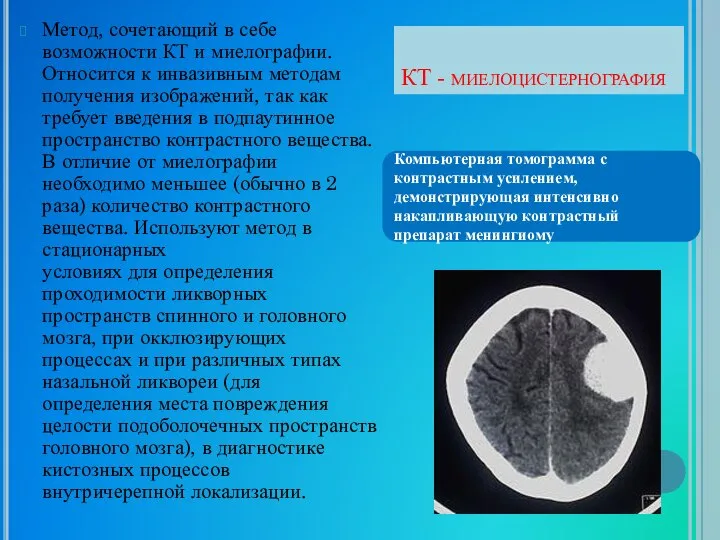 КТ - миелоцистернография Метод, сочетающий в себе возможности КТ и миелографии.